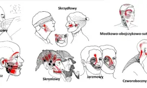 Ilustracje pokazują punkty spustowe bólu żuchwy i głowy, związane z różnymi mięśniami.