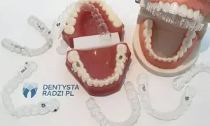Aparat na dolne zęby: Ile naprawdę kosztuje? Ceny, typy, raty.