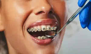 Uśmiechnięta kobieta z aparatem na zęby, który można zdobyć na raty. Dentysta bada jej uzębienie lusterkiem.