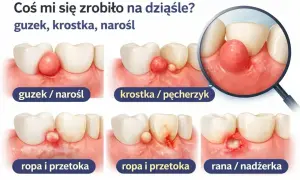 Ilustracja pokazuje różne zmiany na dziąśle: guzek, krostkę, ropę i przetokę, a także ranę.