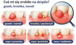 Ilustracja pokazuje różne zmiany na dziąśle: guzek, krostkę, ropień i ranę. Narośl na dziąśle może przybierać różne formy.