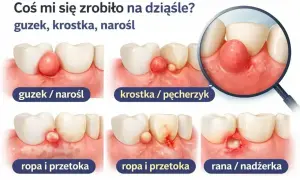 Ilustracja pokazuje różne zmiany na dziąśle: guzek, krostkę, ropę i przetokę, a także ranę. Próchnica przy dziąśle może objawiać się w różny sposób.