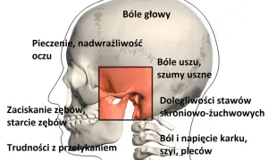 Ilustracja pokazuje objawy TMJ: bóle głowy, uszu, problemy ze stawami skroniowo-żuchwowymi, pieczenie oczu, zaciskanie zębów, trudności z przełykaniem i ból karku.