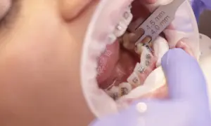 Zbliżenie na usta z aparatem ortodontycznym, ortodonta mierzy zęby narzędziem.