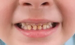 Bruksizm u dzieci: Jak pomóc, gdy zgrzyta zębami w nocy?