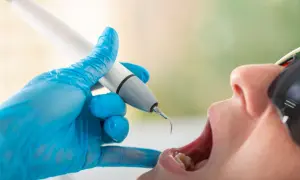 Dentysta usuwa kamień z zębów. Czy usuwanie kamienia boli? Nowoczesne metody są zazwyczaj bezbolesne.