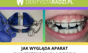 Aparat ortodontyczny z NFZ: Tylko dla dzieci? Prawda o refundacji