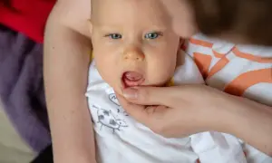 Dziecko ma krwiaka na dziąśle po uderzeniu. Widoczny jest mały, ciemny obrzęk.