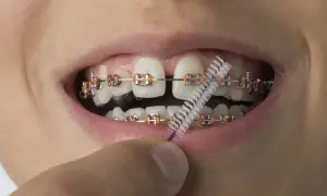 Co jeść w aparacie na zęby? Twoja biała i czarna lista produktów