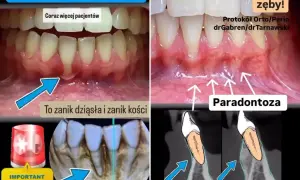Zmagasz się z paradontozą? Zobacz, jak specjalna pasta na cofające się dziąsła może pomóc w odbudowie kości i uratować Twoje zęby.