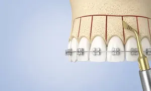 Model szczęki z zaznaczoną kortykotomią i narzędziem stomatologicznym.