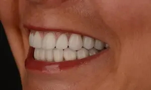Ile trwa wybielanie zębów? Szybko czy tygodniami? Pełny przewodnik.
