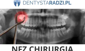 Usuwanie zęba na NFZ w Łodzi: Adresy, zasady, co refunduje?