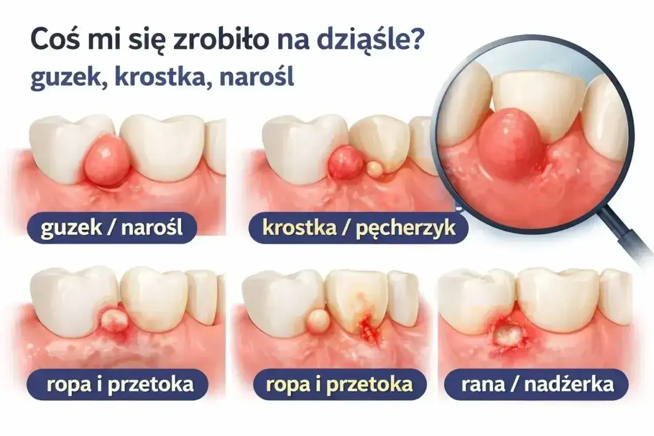 Ilustracja pokazuje różne zmiany na dziąśle: guzek, krostkę, ropę i przetokę, a także ranę. Próchnica przy dziąśle może objawiać się w różny sposób.