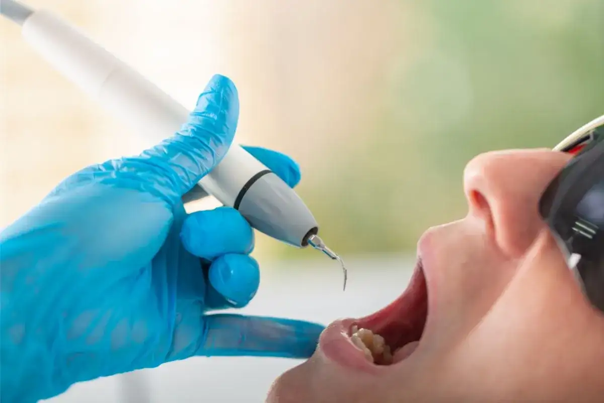 Dentysta usuwa kamień z zębów. Czy usuwanie kamienia boli? Nowoczesne metody są zazwyczaj bezbolesne.