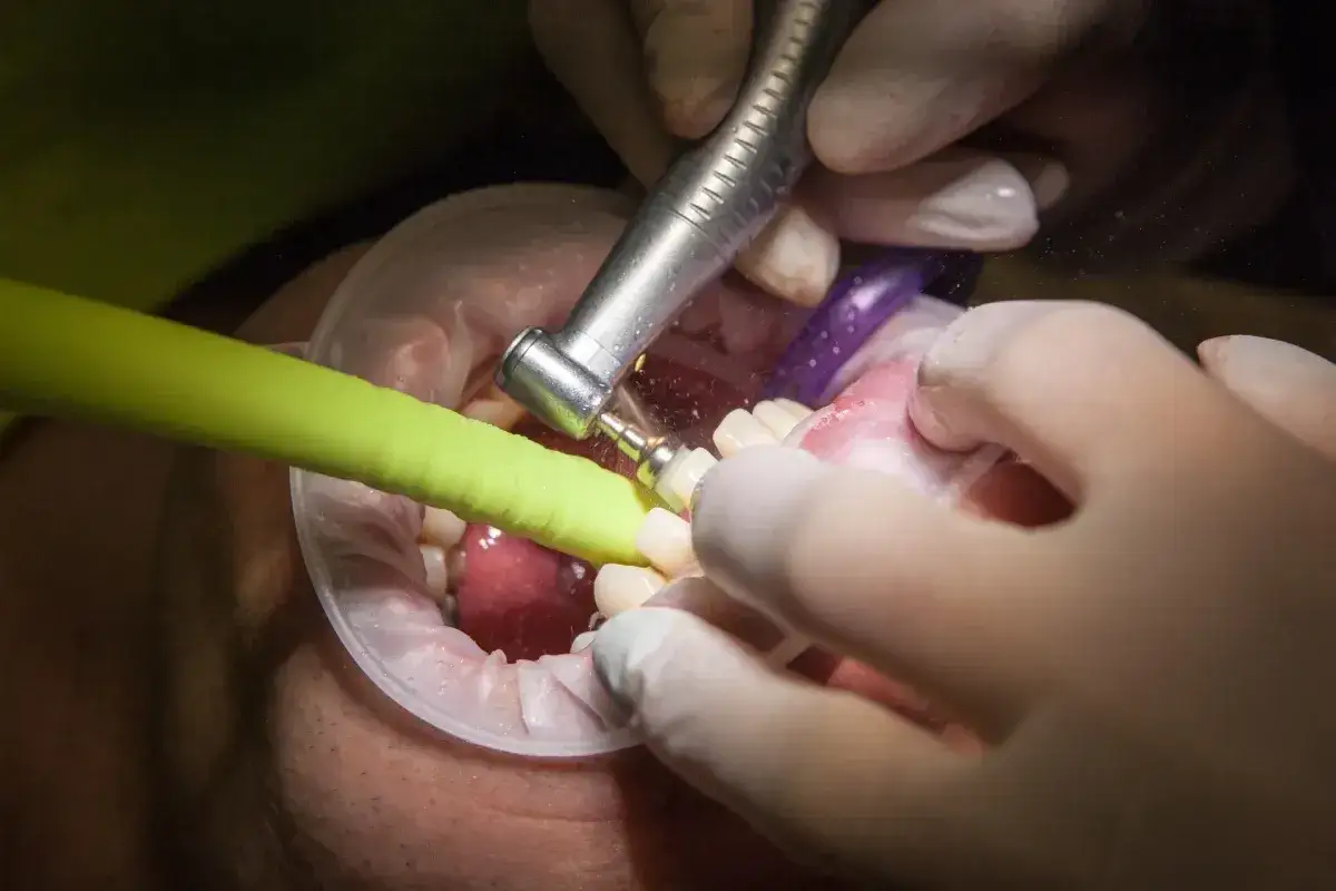 Zabieg stomatologiczny: dentysta wykonuje kortykotomię, używając wiertła i ssaka.