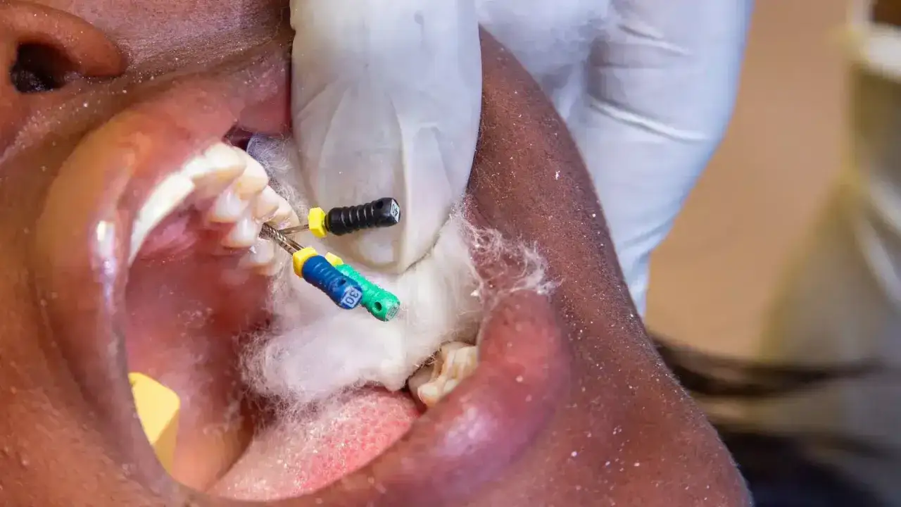 Dentysta używa narzędzi do kanałów korzeniowych, w tym artykainy, podczas leczenia zęba.