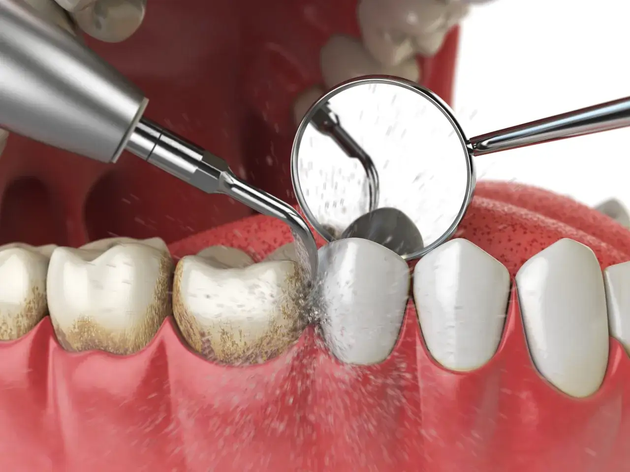 Dentysta usuwa kamień nazębny z zęba za pomocą ultradźwięków. Lustro dentystyczne odbija zabieg.