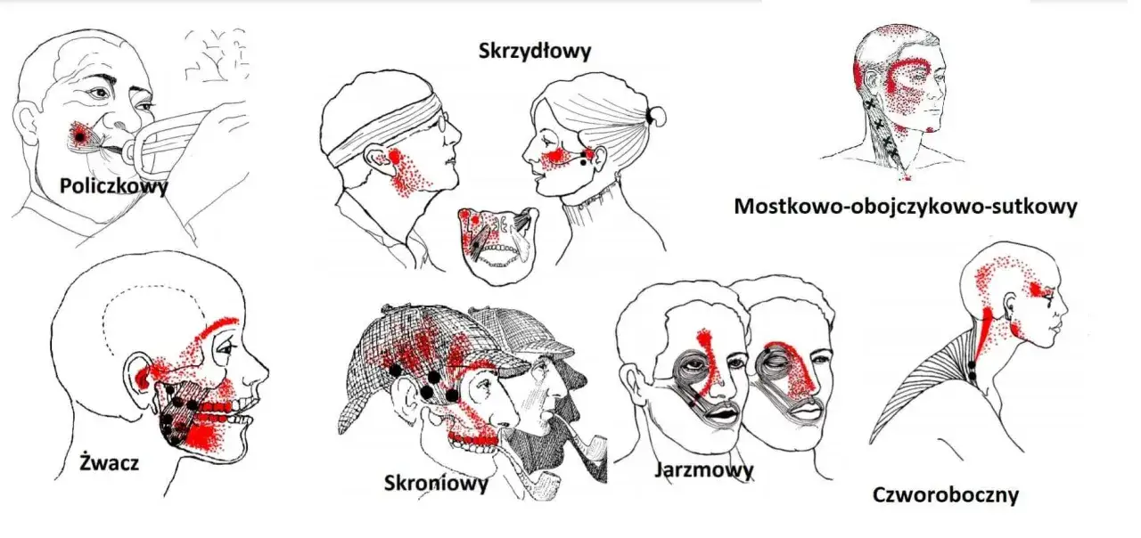 Ilustracje przedstawiają punkty spustowe bólu związane z różnymi rodzajami szczękościsku, np. policzkowego, skroniowego, jarzmowego.