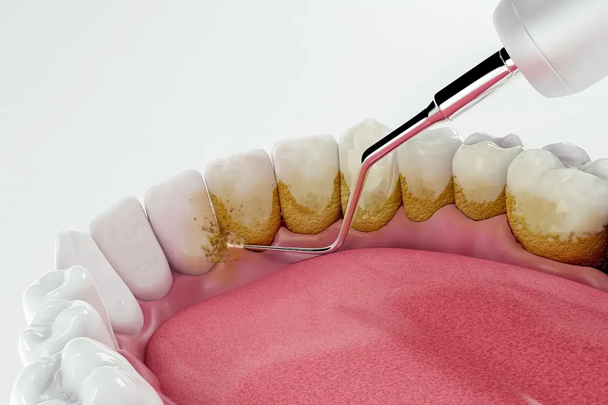 Usuwanie kamienia nazębnego NFZ: ultradźwiękowe czyszczenie zębów z widocznym osadem i narzędziem dentystycznym.