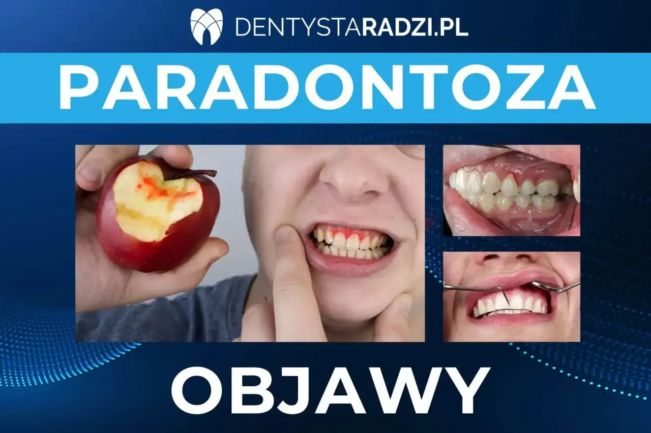 Krwawiące dziąsła po ugryzieniu jabłka, odsłonięte szyjki zębów i cofające się dziąsła to objawy zaawansowanej paradontozy.