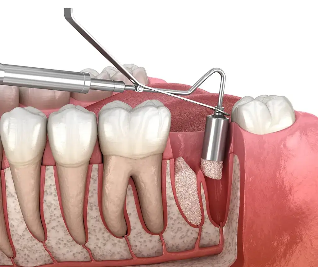 dentysta ekstrakcja zęba opatrunek