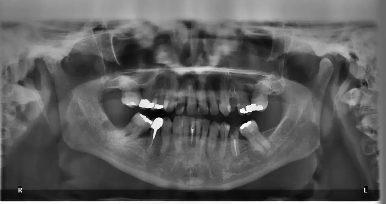 Pantomogram z widocznymi zębami, wypełnieniami i implantami. Sprawdź pantomogram cena, aby dowiedzieć się więcej o kosztach.