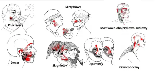 Ilustracje pokazują punkty spustowe bólu żuchwy i głowy, związane z różnymi mięśniami.