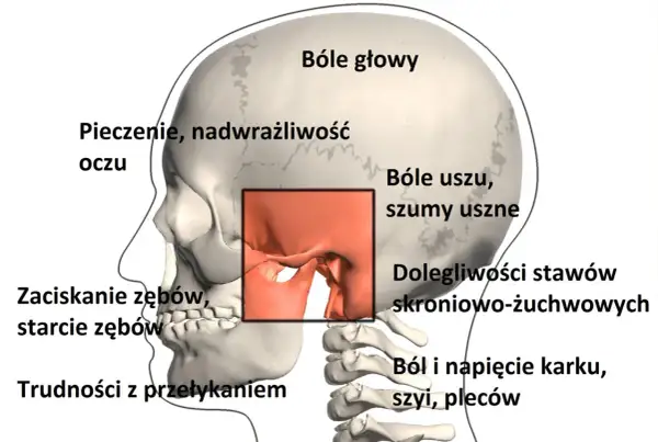 Ilustracja pokazuje objawy TMJ: bóle głowy, uszu, problemy ze stawami skroniowo-żuchwowymi, pieczenie oczu, zaciskanie zębów, trudności z przełykaniem i ból karku.