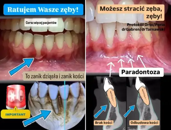 Zmagasz się z paradontozą? Zobacz, jak specjalna pasta na cofające się dziąsła może pomóc w odbudowie kości i uratować Twoje zęby.